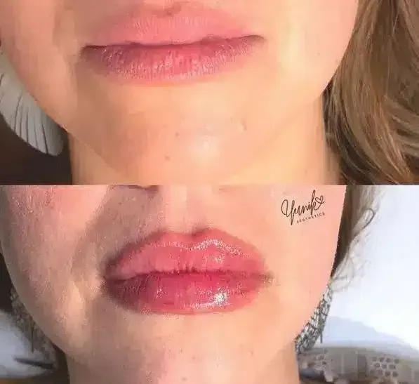 A Before and After Photo of A Woman 's Lips Surgery.