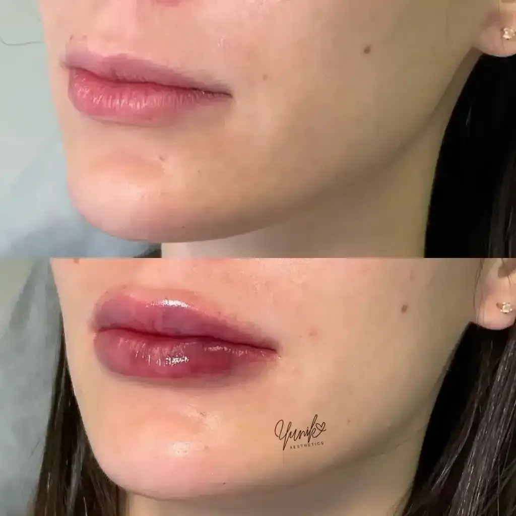 A Before and After Photo of A Woman 's Lips Surgery.