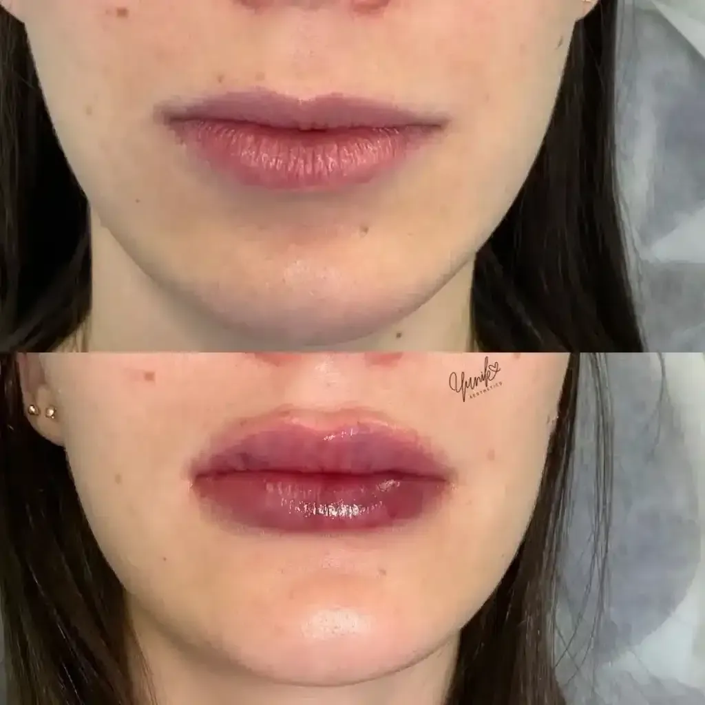 A Before and After Photo of A Woman 's Lips Treatment.