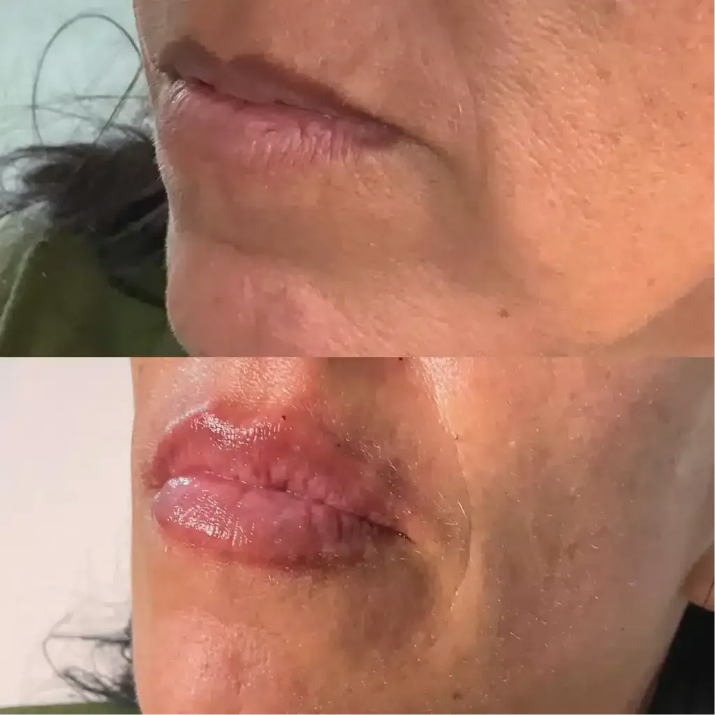 Lip Fillers