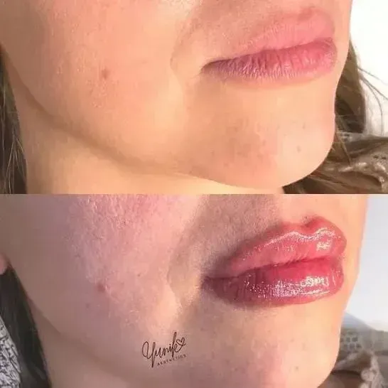 A Before and After Side View Photo of A Woman 's Lips.
