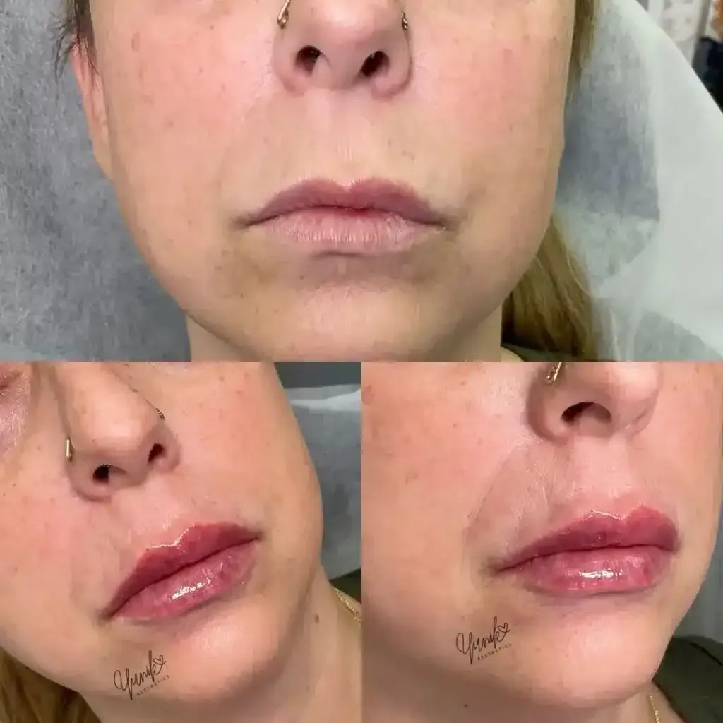 A Woman with A Nose Ring Has a Before and After Picture of Her Lips.