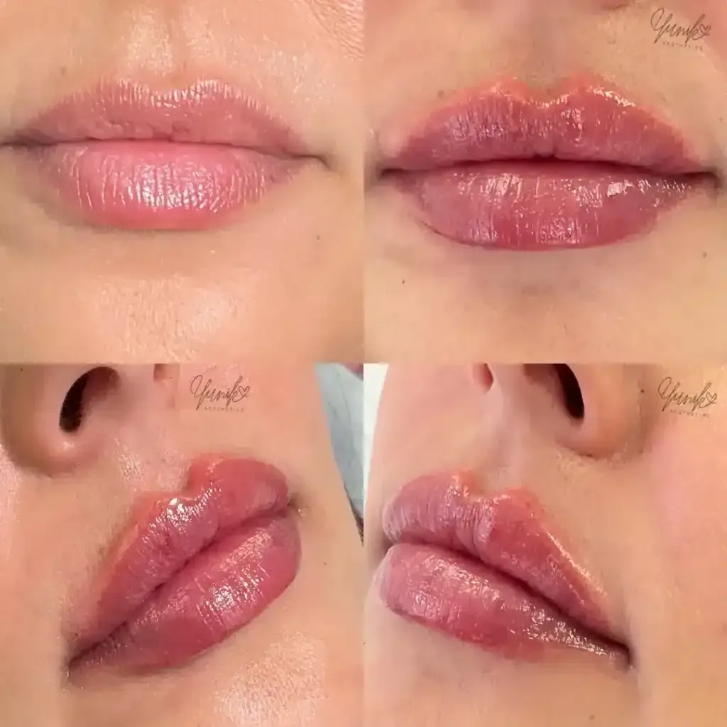 A Collage of Four Photos of A Woman 's Lips Before and After a Lip Lift