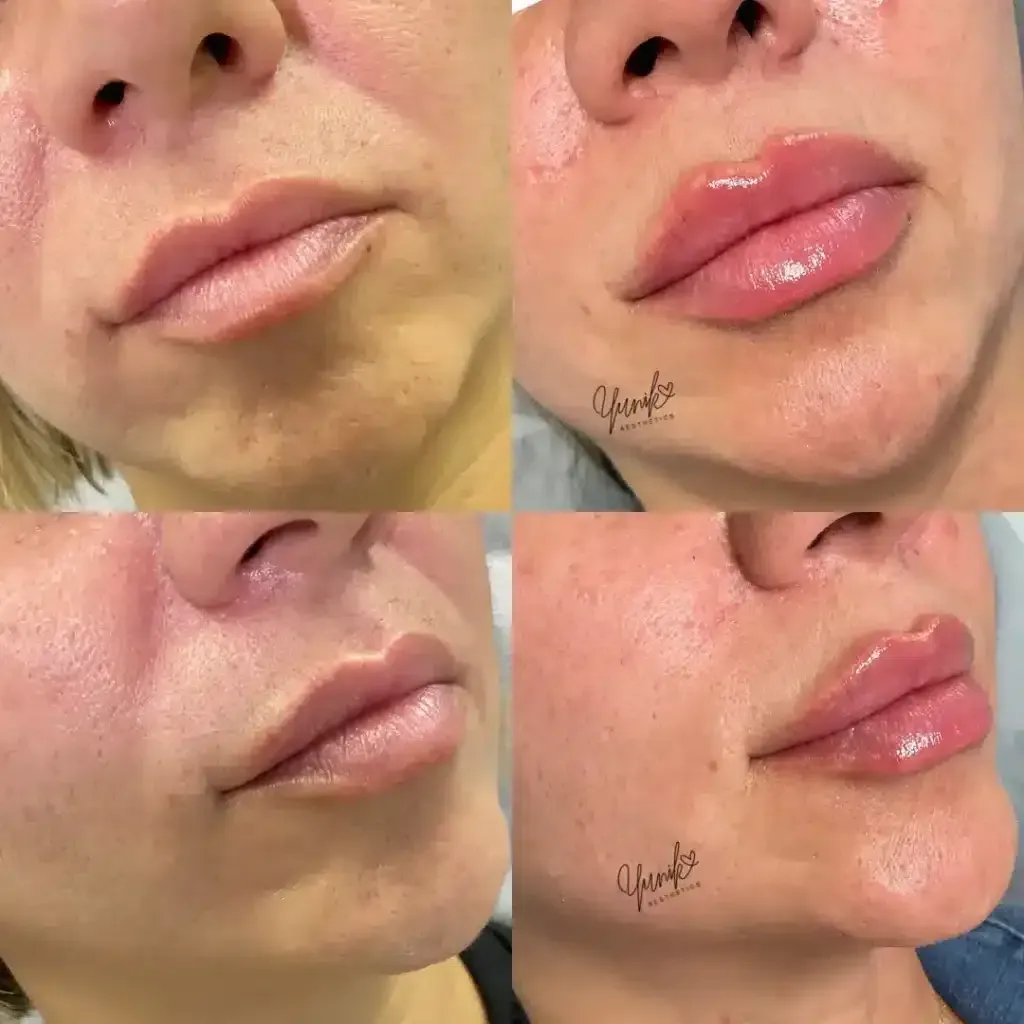 A Collage of Four Photos of A Woman 's Lips Before and After Lip Surgery.