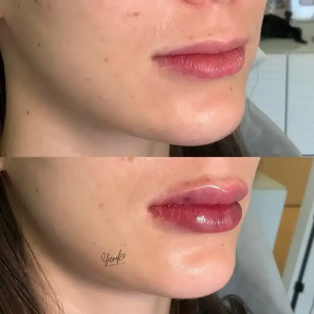 A Before and After Photo of A Woman 's Lips.