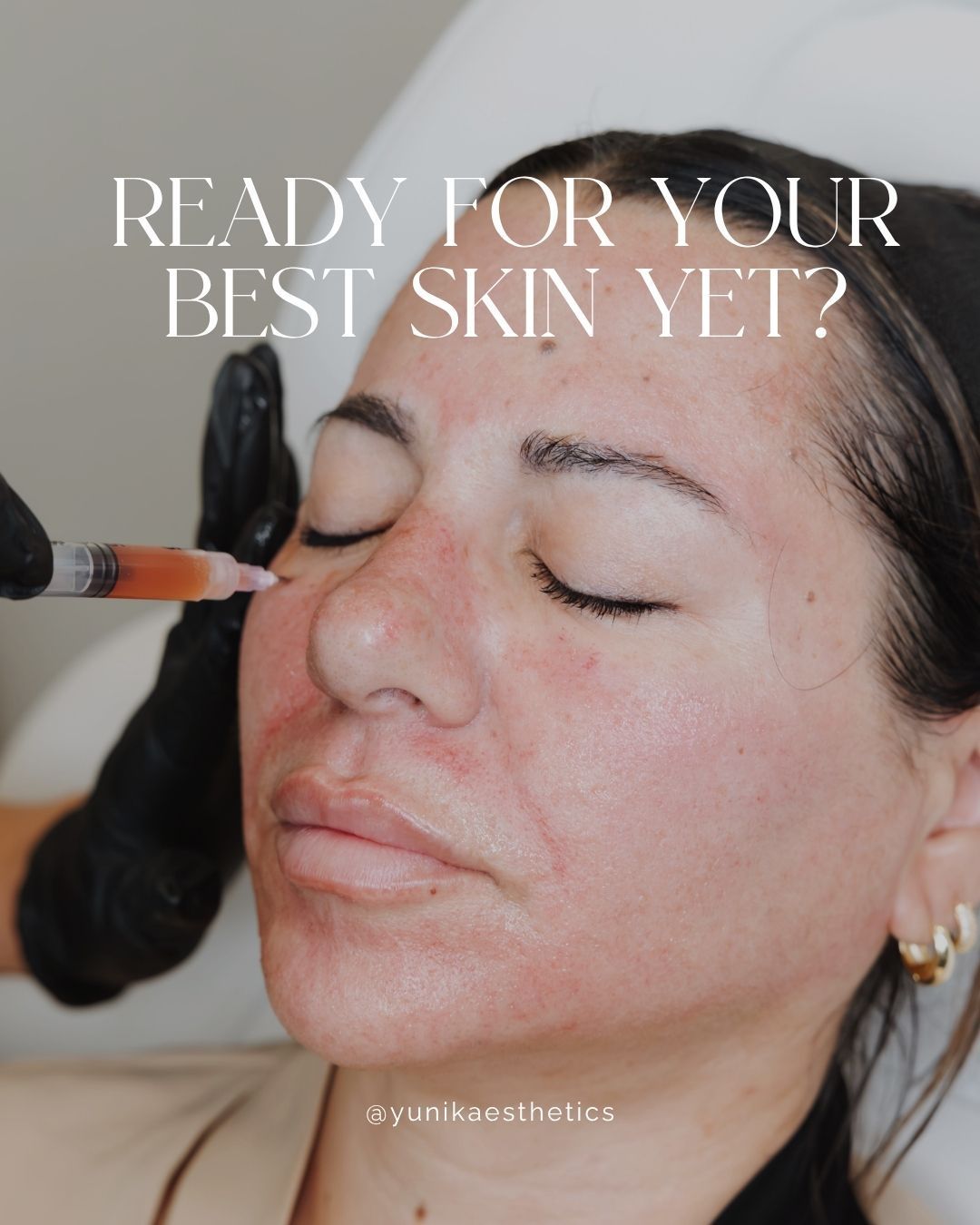 Cosmetic treatment applied to a woman’s cheek with text, “Ready for your best skin yet?”