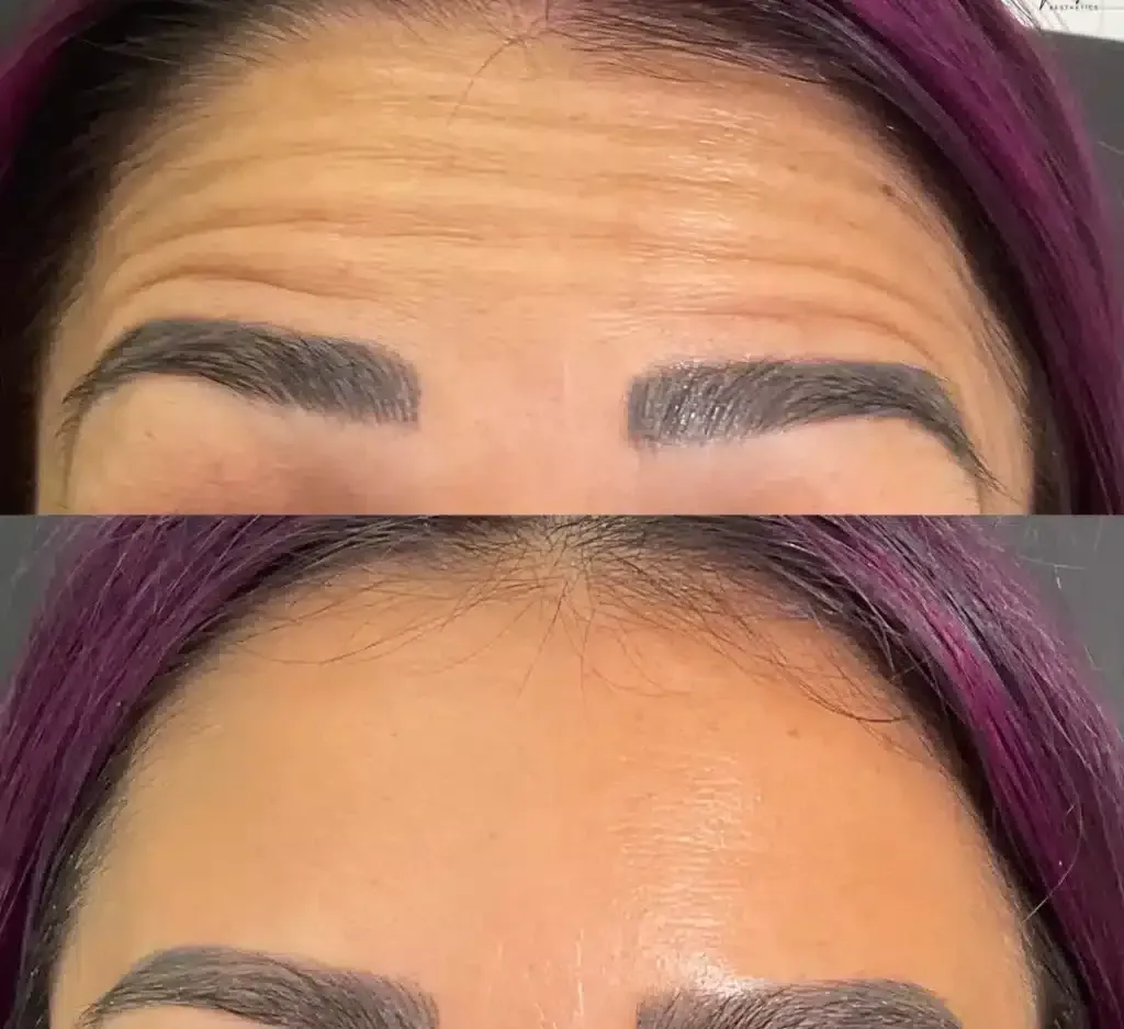 A Before and After Photo of A Woman 's Forehead with Purple Hair.
