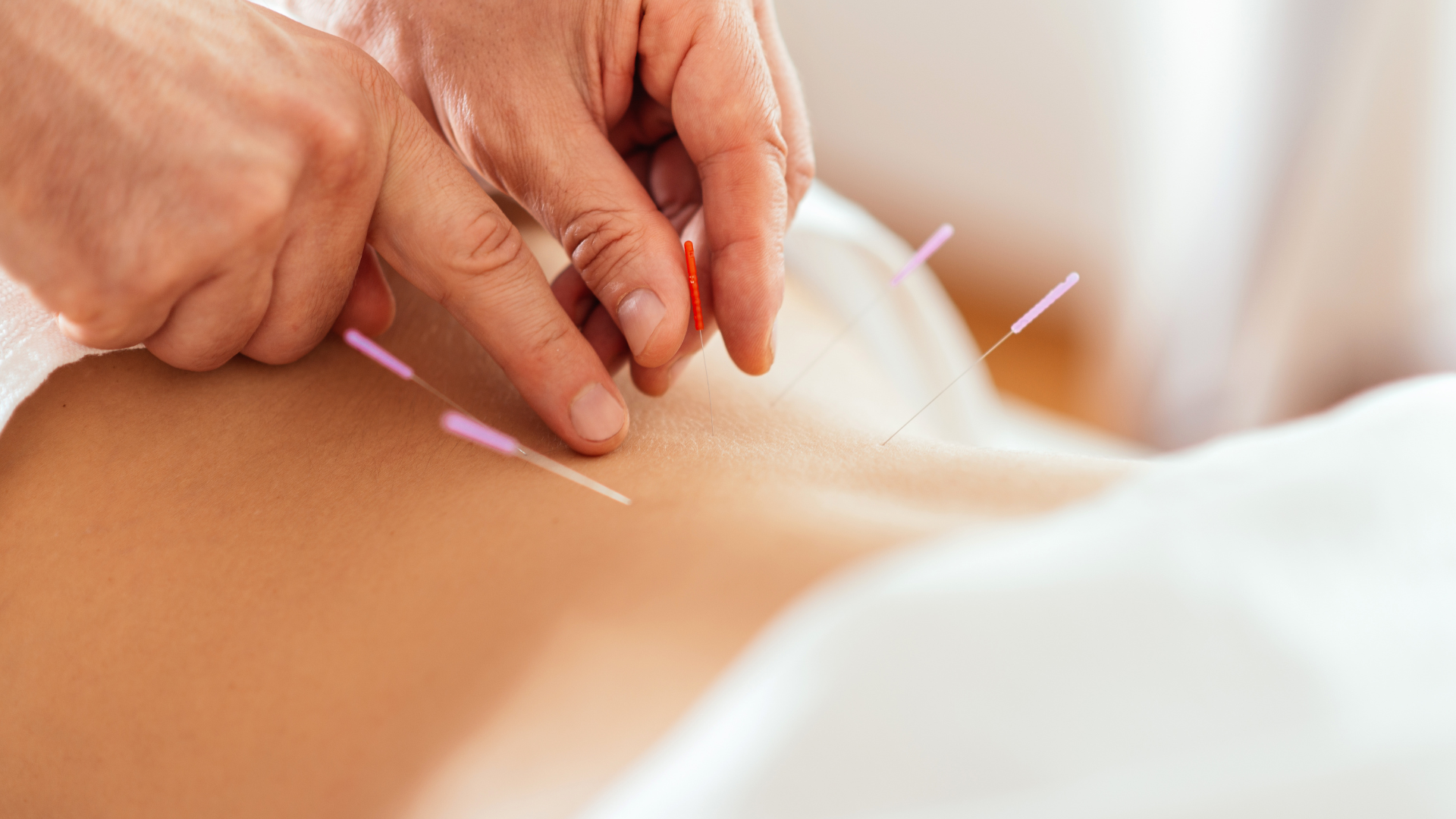 Hands inserting acupuncture needles into a person's back, in a white-sheeted setting.