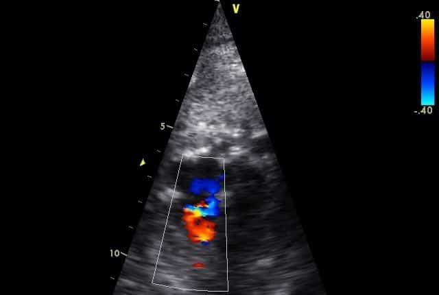 Color Doppler ultrasound of heart, showing blood flow: red (away), blue (toward) with turbulent flow in the lower chamber.