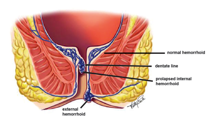hemorrhoid symptoms external internal