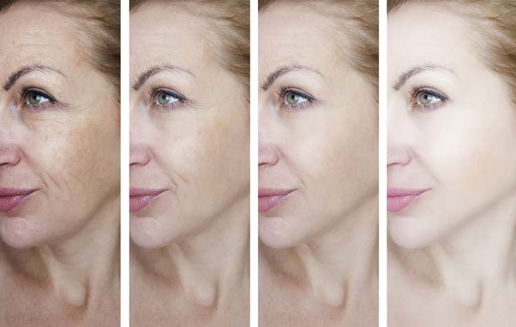 Female-eye-wrinkles-before-and-after-treatments