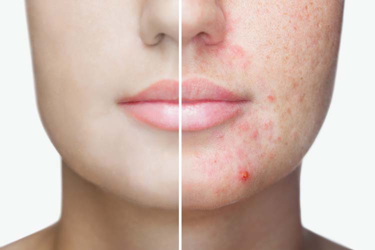 Photo-before-and-after-treatment-for-acne