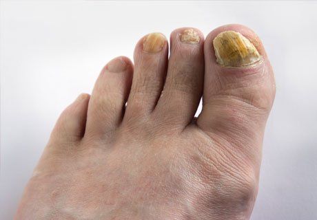 What Causes Toenail Fungus and How can I get Rid of it Before Summer?:  Premier Foot & Ankle: Podiatrists