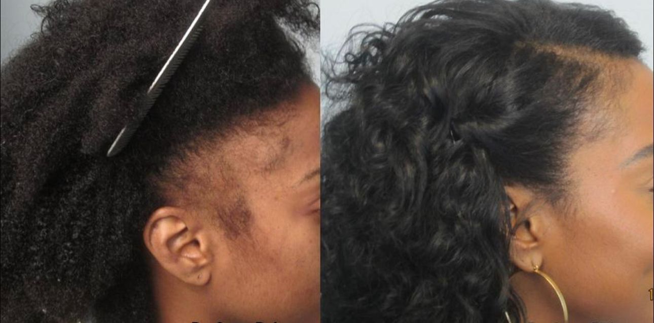 a before and after photo of a female with afro hair who has undergone an FUE hair transplant
