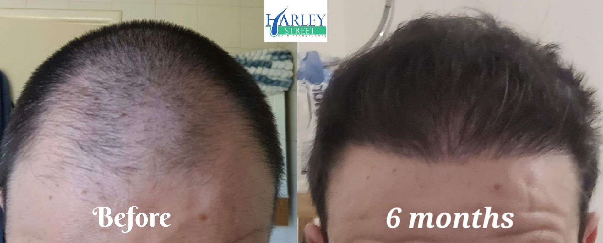 FUE hairline transplant