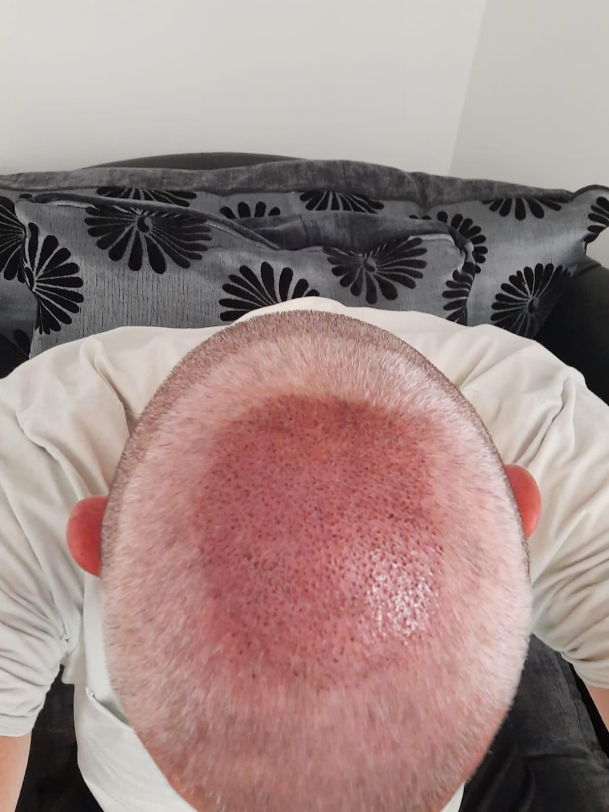 A picture of a male with balding around the crown area