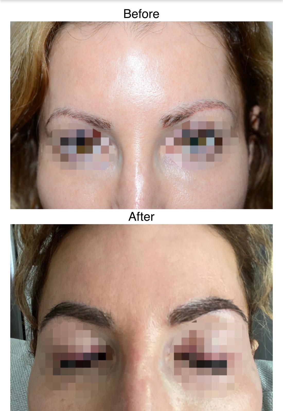 A female before and after undergoing a FUE eyebrow hair transplant
