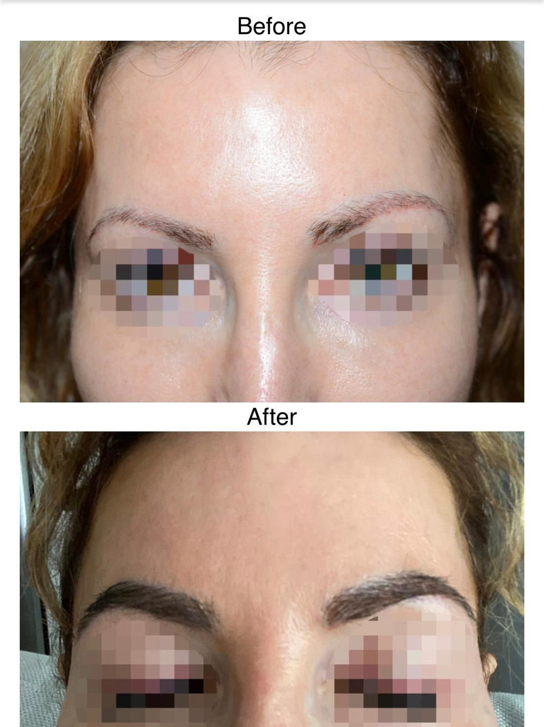 A before and after photo of a female eyebrow hair transplant