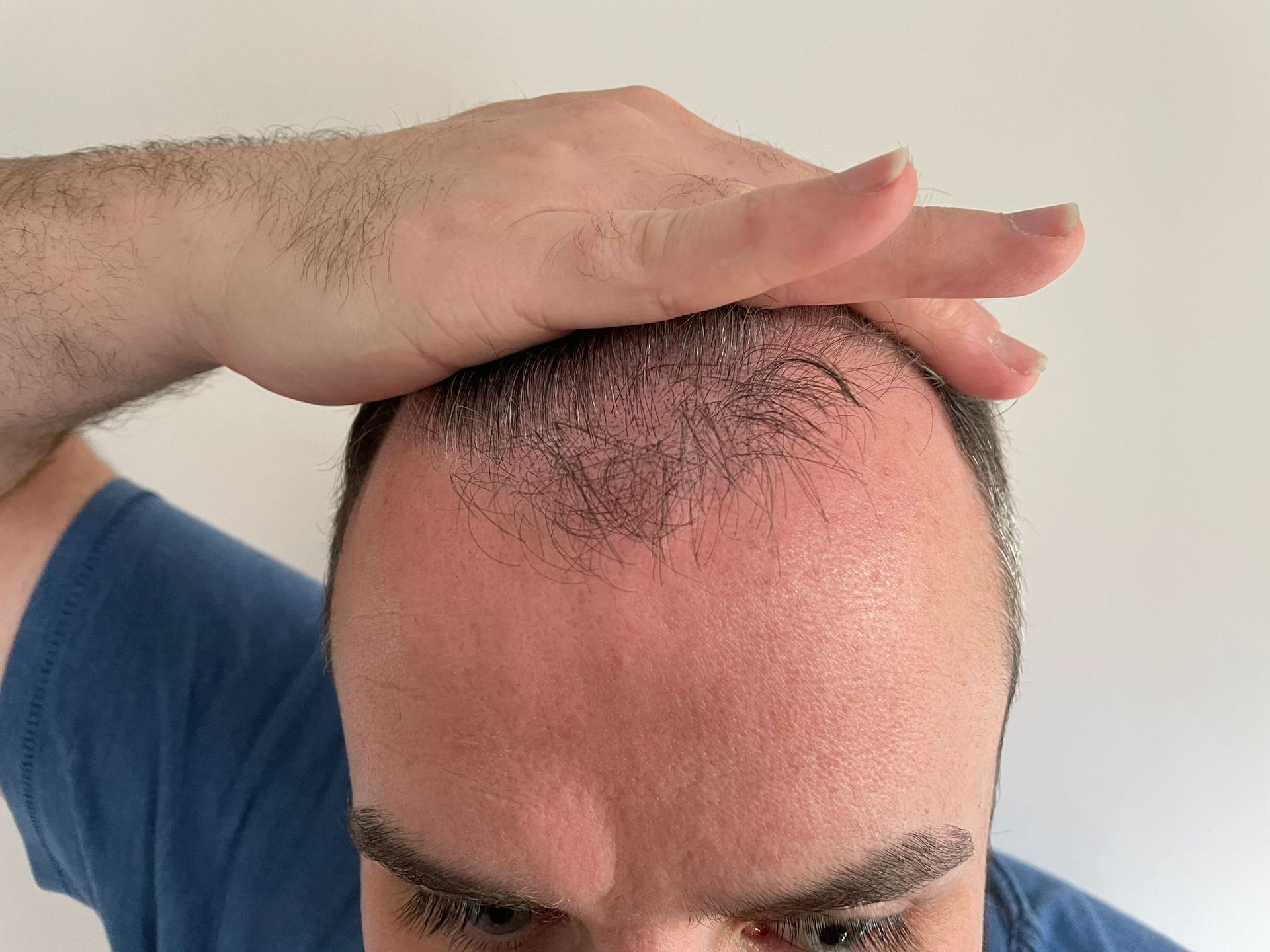 A picture of a male prior to a hair transplant procedure