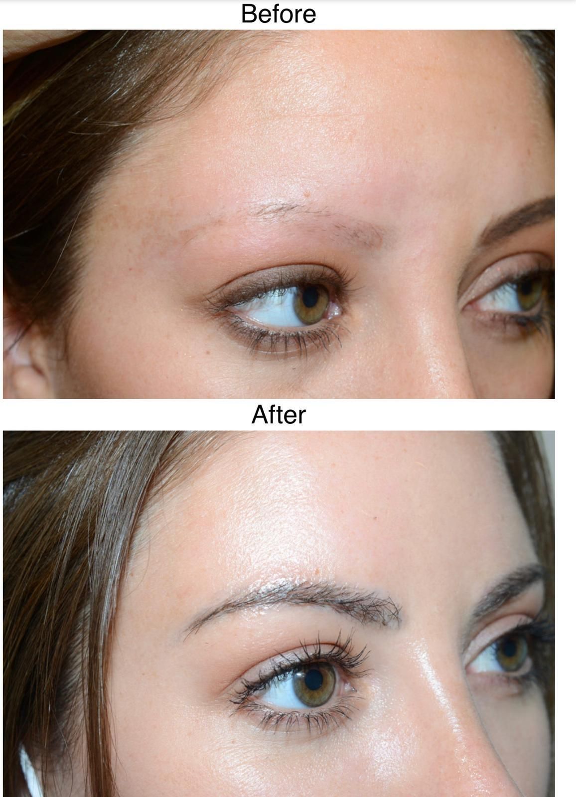 A female before and after undergoing a FUE eyebrow hair transplant