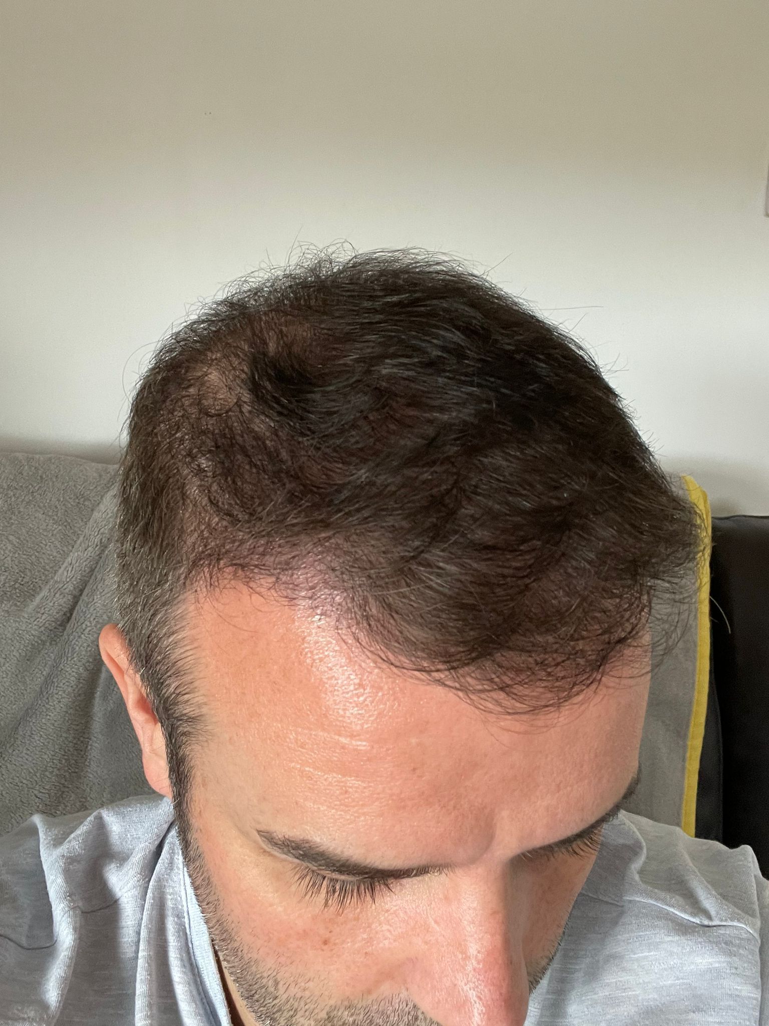 A picture of a male after a crown hair transplant
