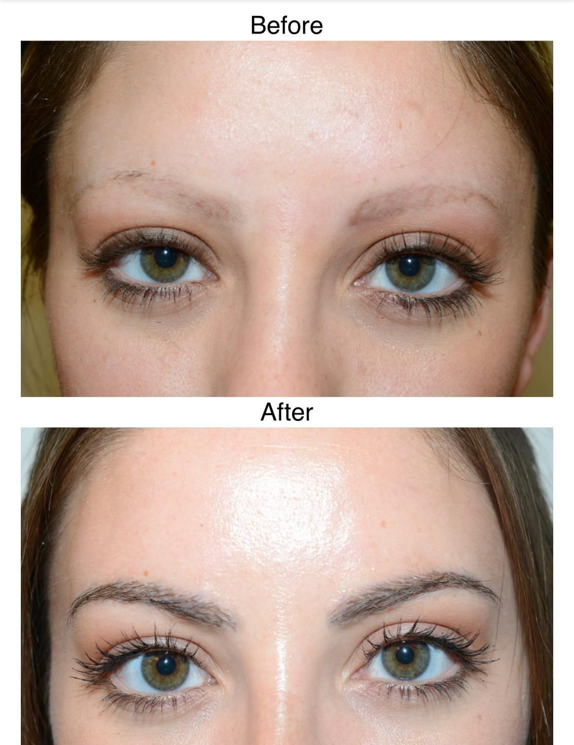 A before and after photo of a female eyebrow hair transplant