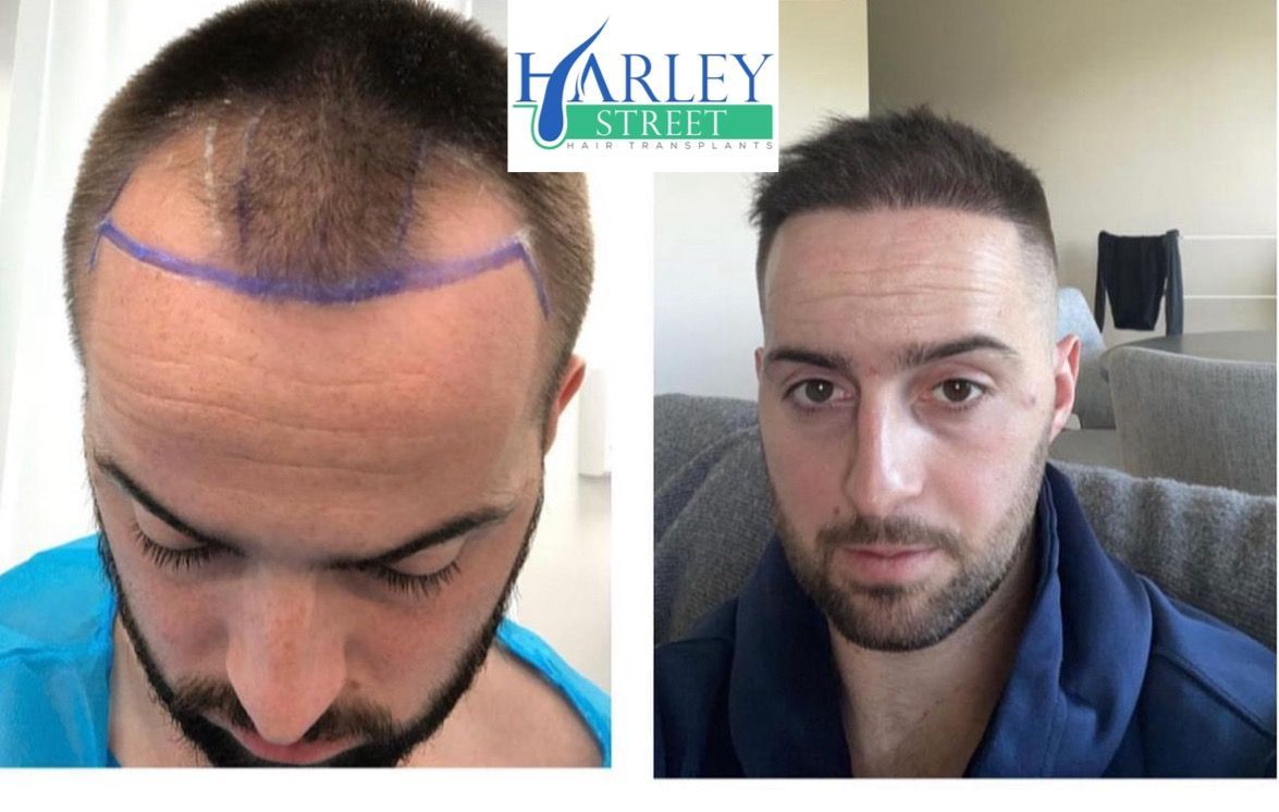 FUE hairline transplant