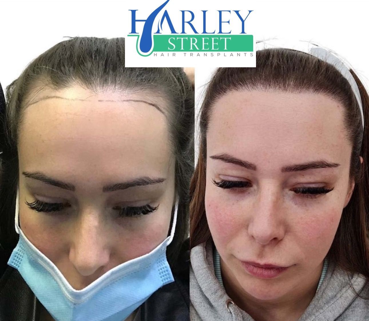 female hairline FUE hair transplant