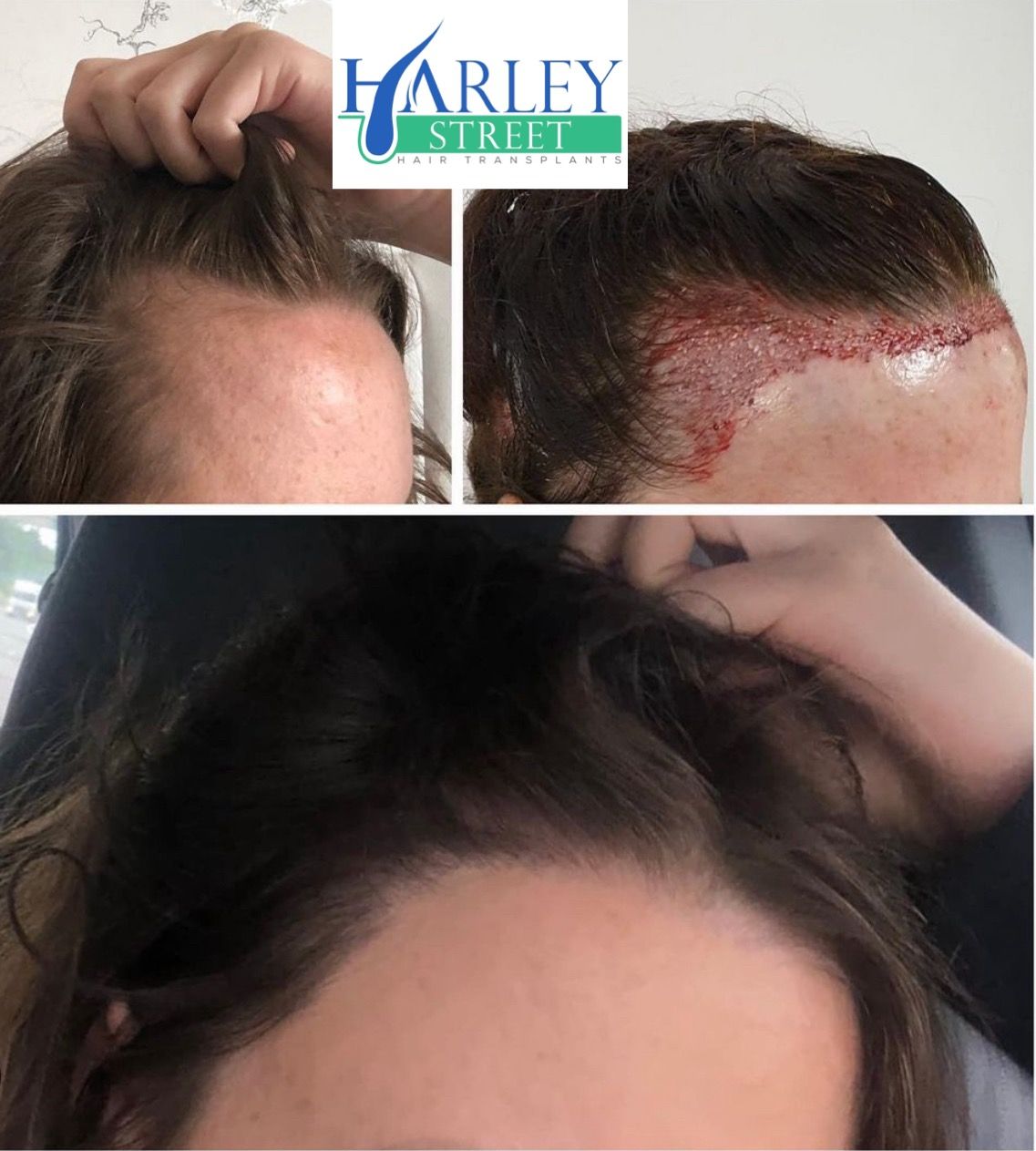 female hairline FUE hair transplant