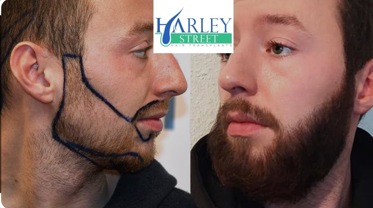 before and after FUE  beard  transplant