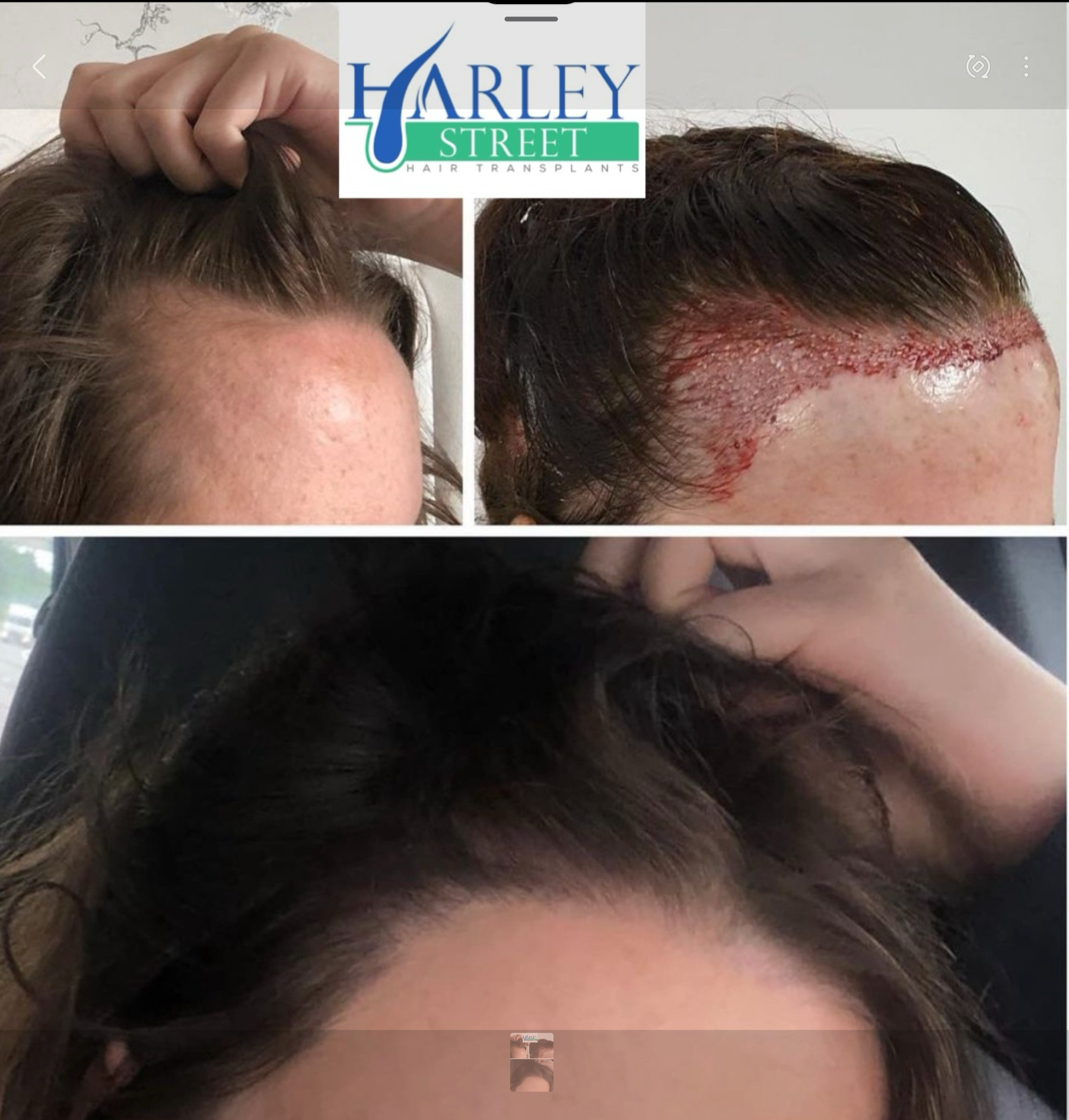 A female undergoing a FUE hair transplant