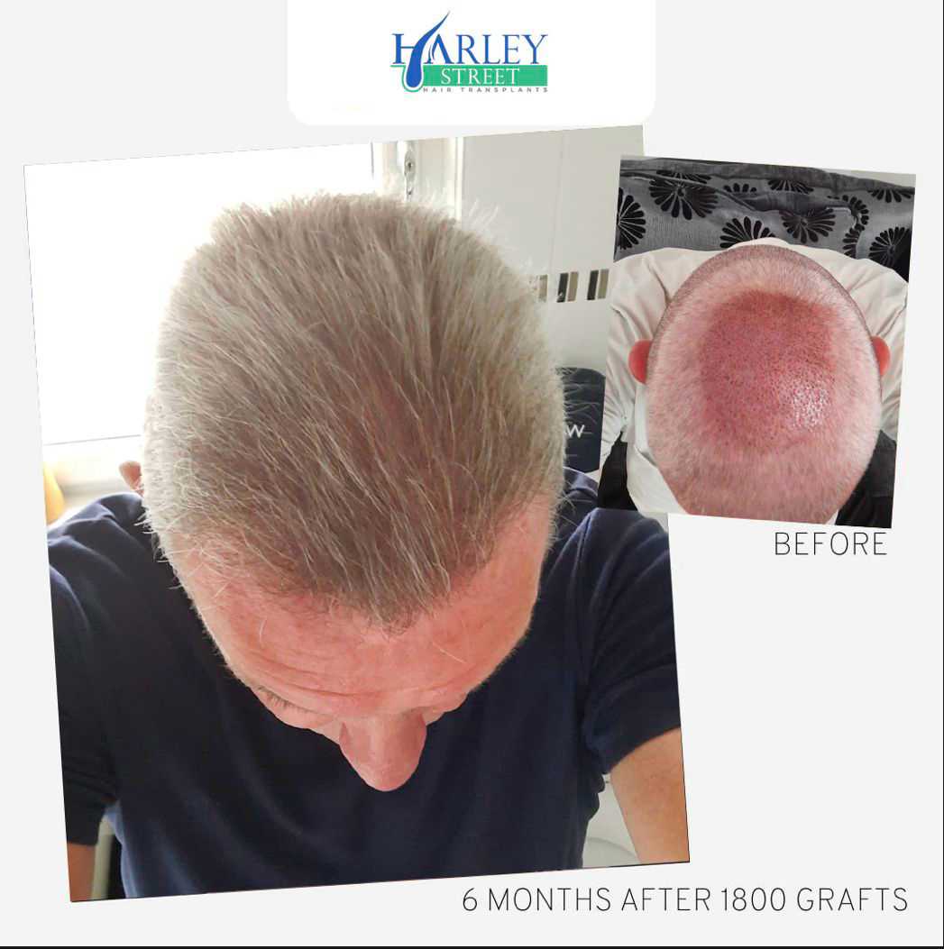 A picture of a male with male pattern baldness around the crown area