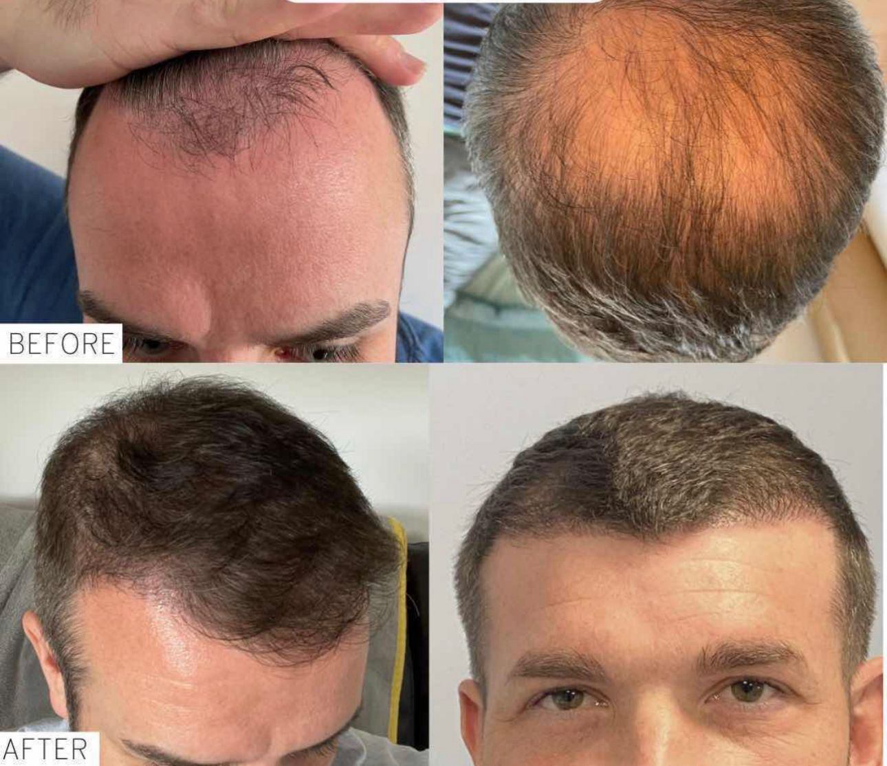 A picture of a male after undergoing a crown hair transplant