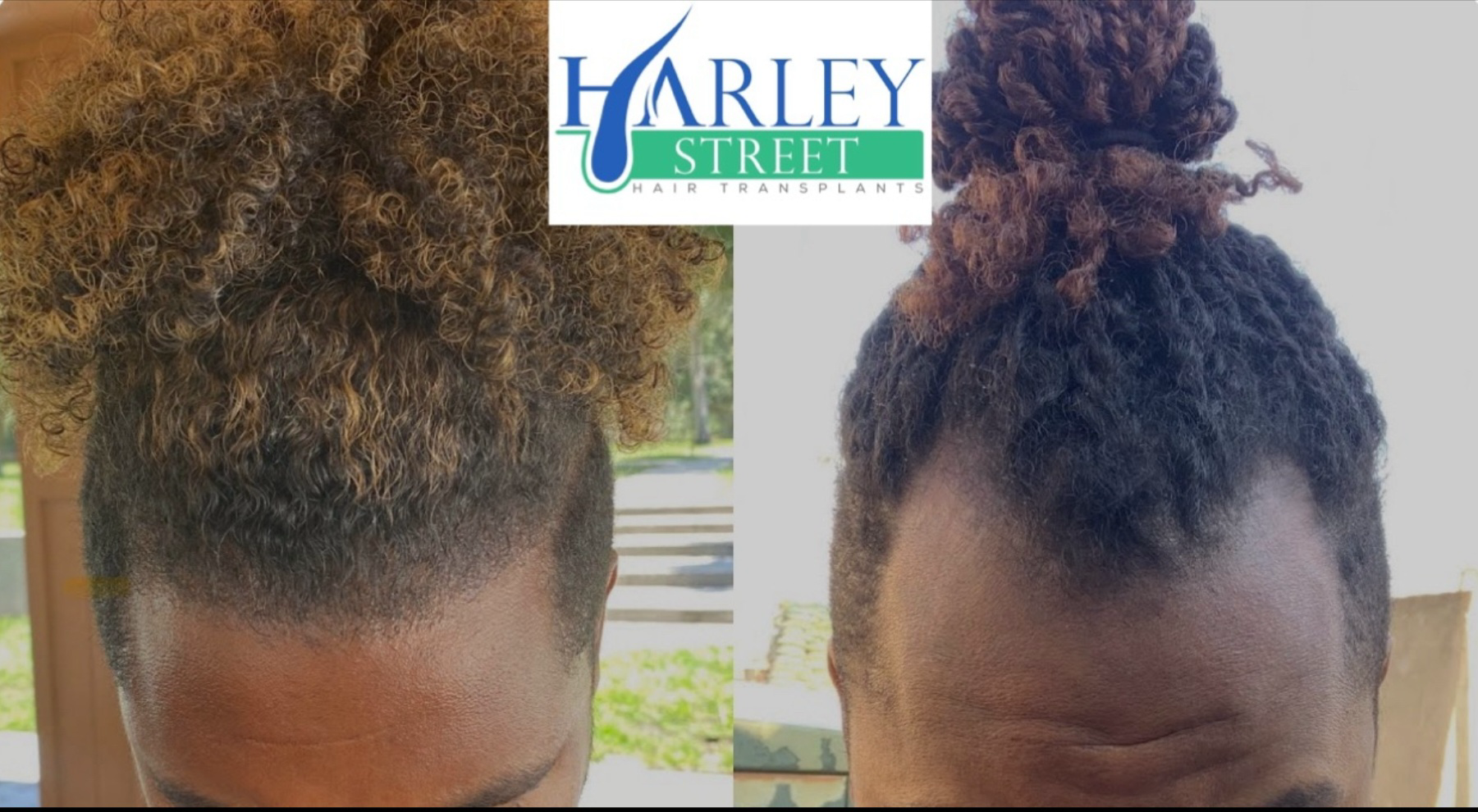 A transgender woman after a hair transplant