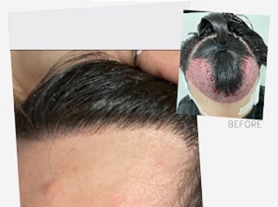 A before and after picture of a male who has undergone FUE surgery
