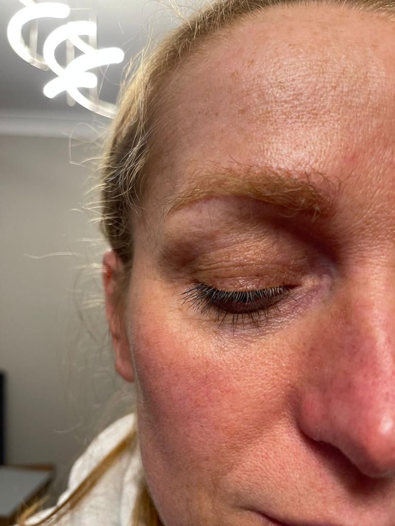 A female after undergoing a FUE eyebrow hair transplant
