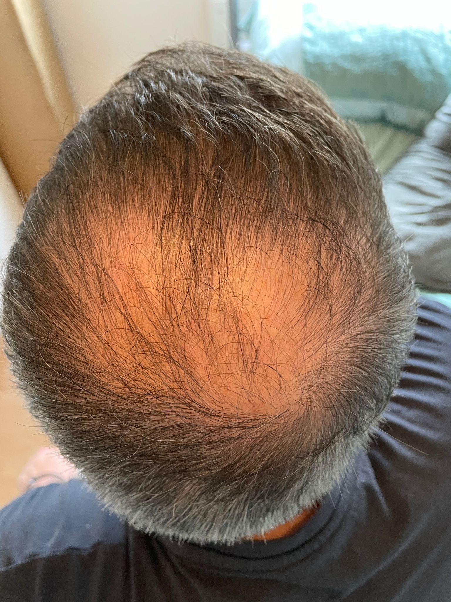 A picture of a male with male pattern baldness around the crown area