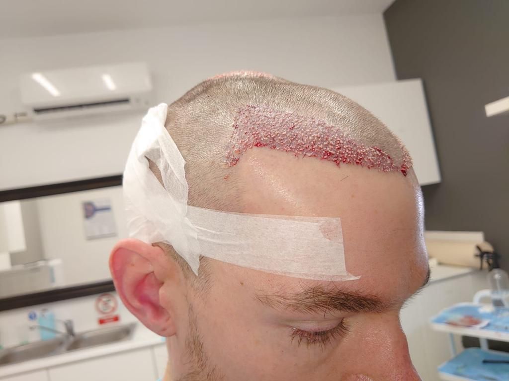 A picture of a male patient undergoing FUE surgery