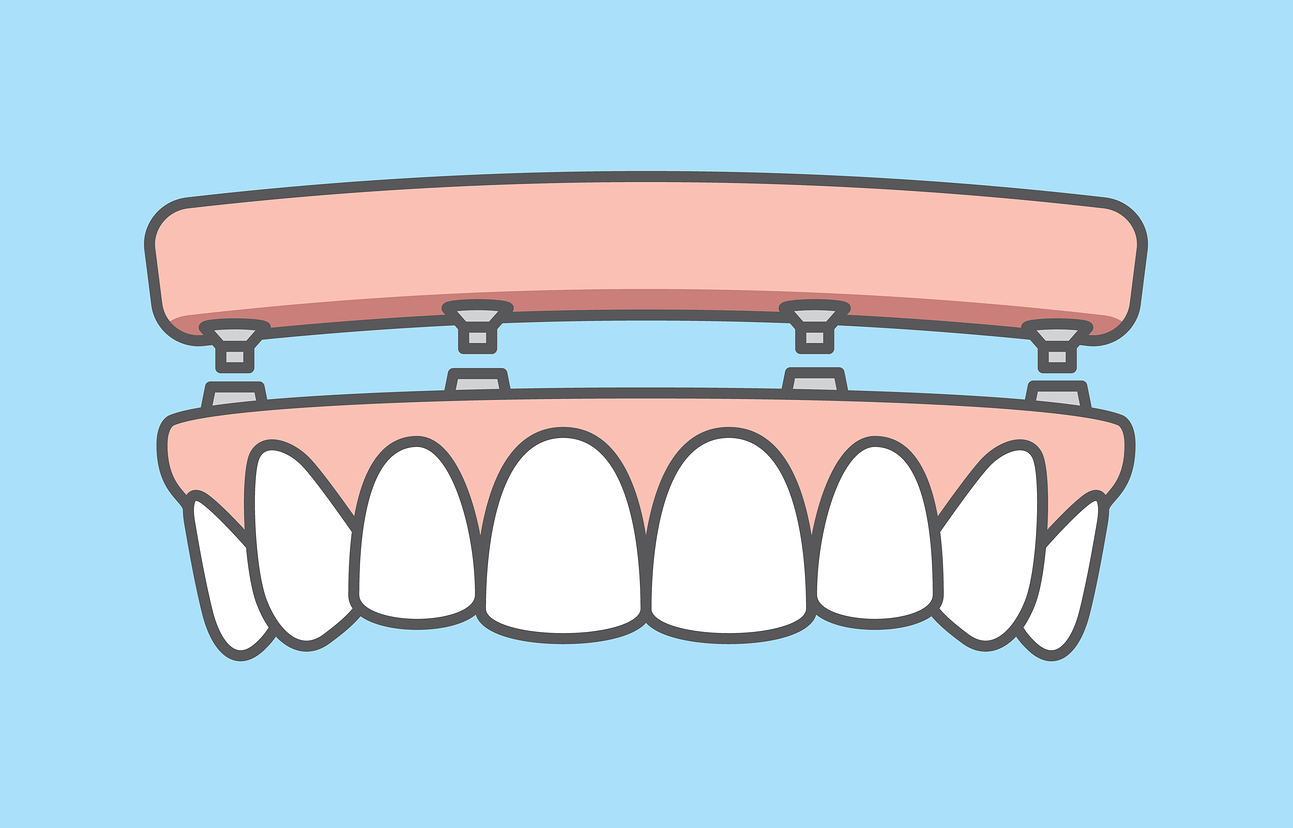 implant removable dentures