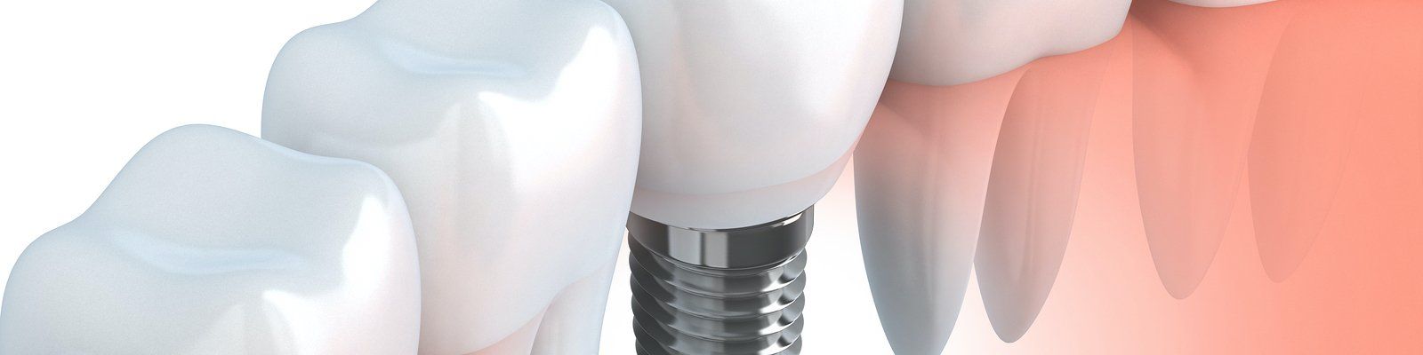 Dental Implants vs Fixed Dental Bridges
