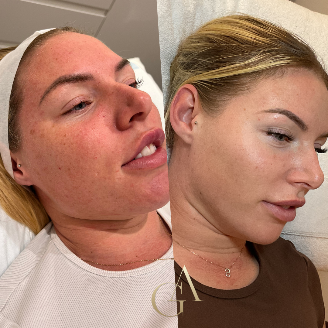 A Woman is Getting a Facial Treatment at a Spa — Gorjess Aesthetics in Corrimal, NSW