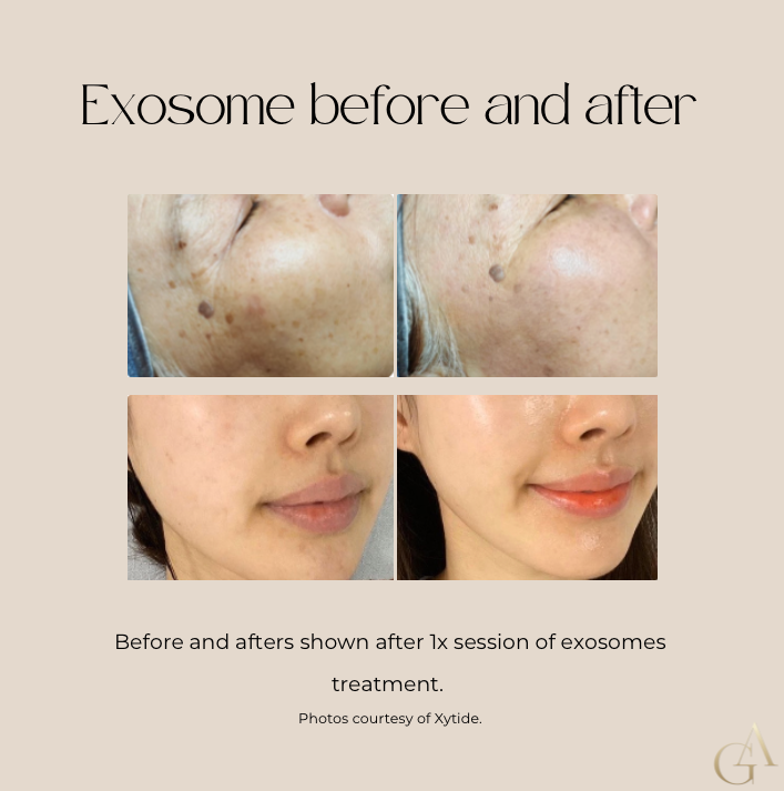 Exosomes Skin Pen Exfoliating Treatment — Gorjess Aesthetics in Corrimal, NSW