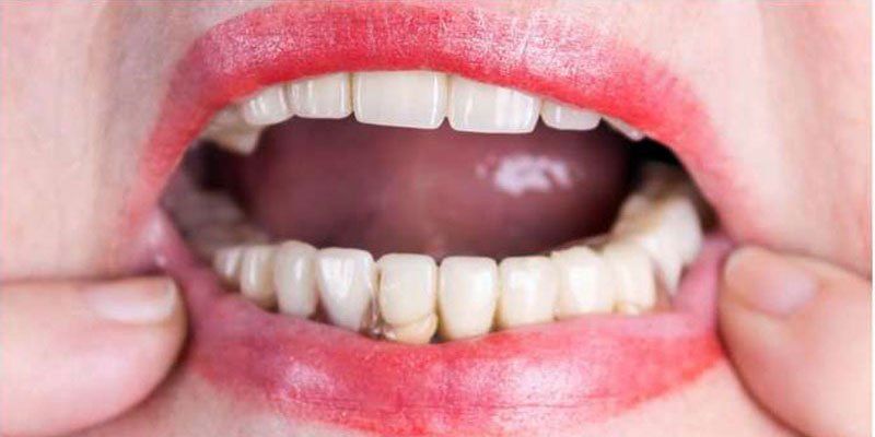 sostituzione denti dopo