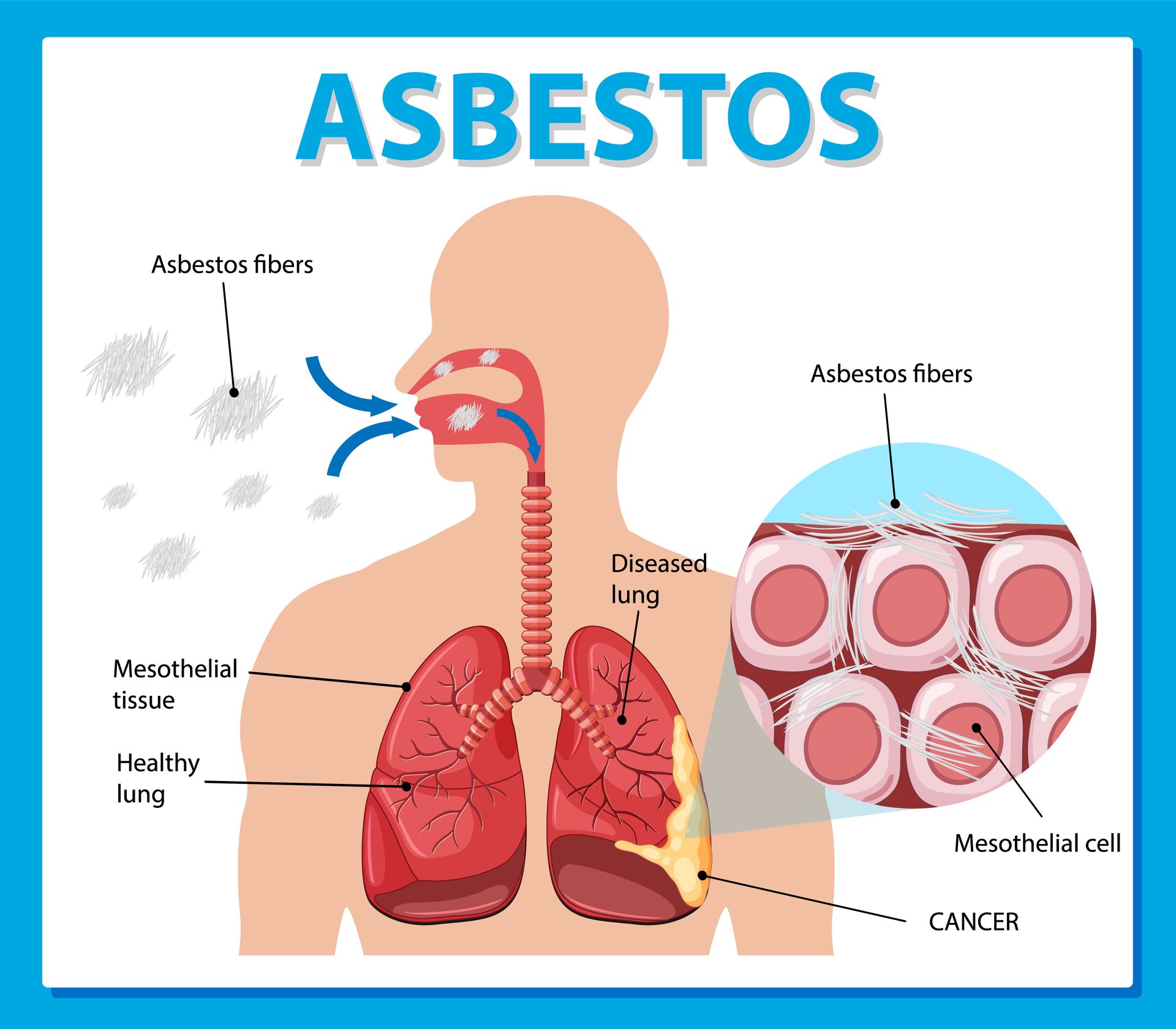 a poster showing the effects of asbestos on the lungs