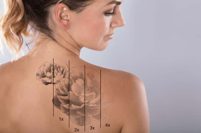 SHOULD YOU CONSIDER LASER TATTOO REMOVAL?