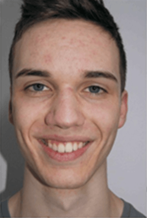 Ein junger Mann mit Akne im Gesicht lächelt in die Kamera