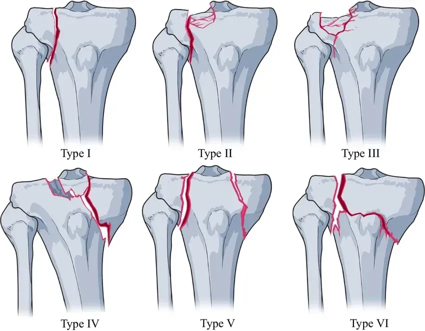 Schatzker classification diagram for tibial plateau fractures