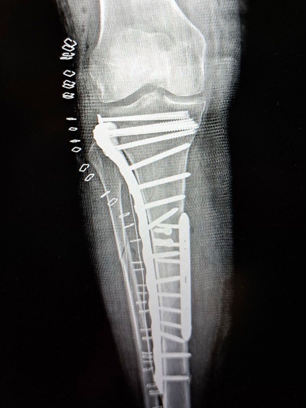 Post-operative imaging after ORIF of tibial plateau fracture