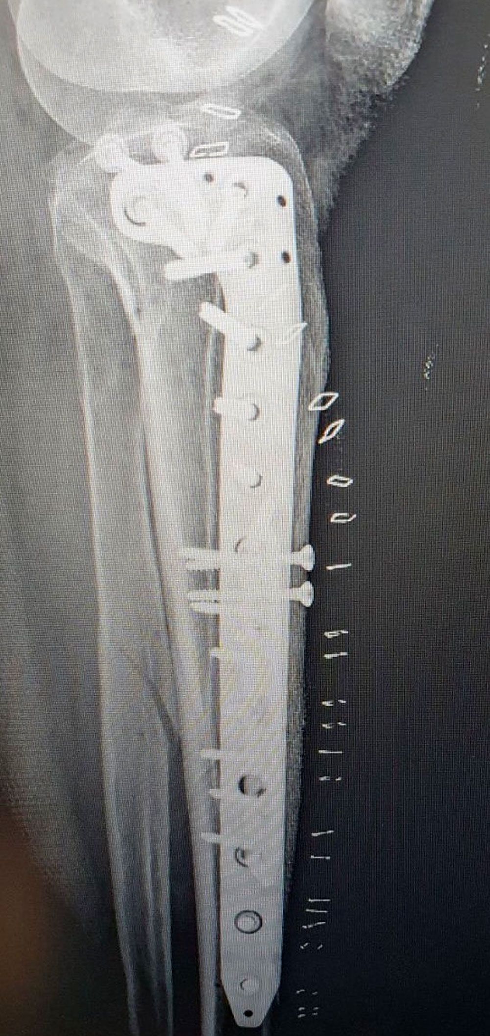Post-operative imaging after ORIF of tibial plateau fracture (view 2)