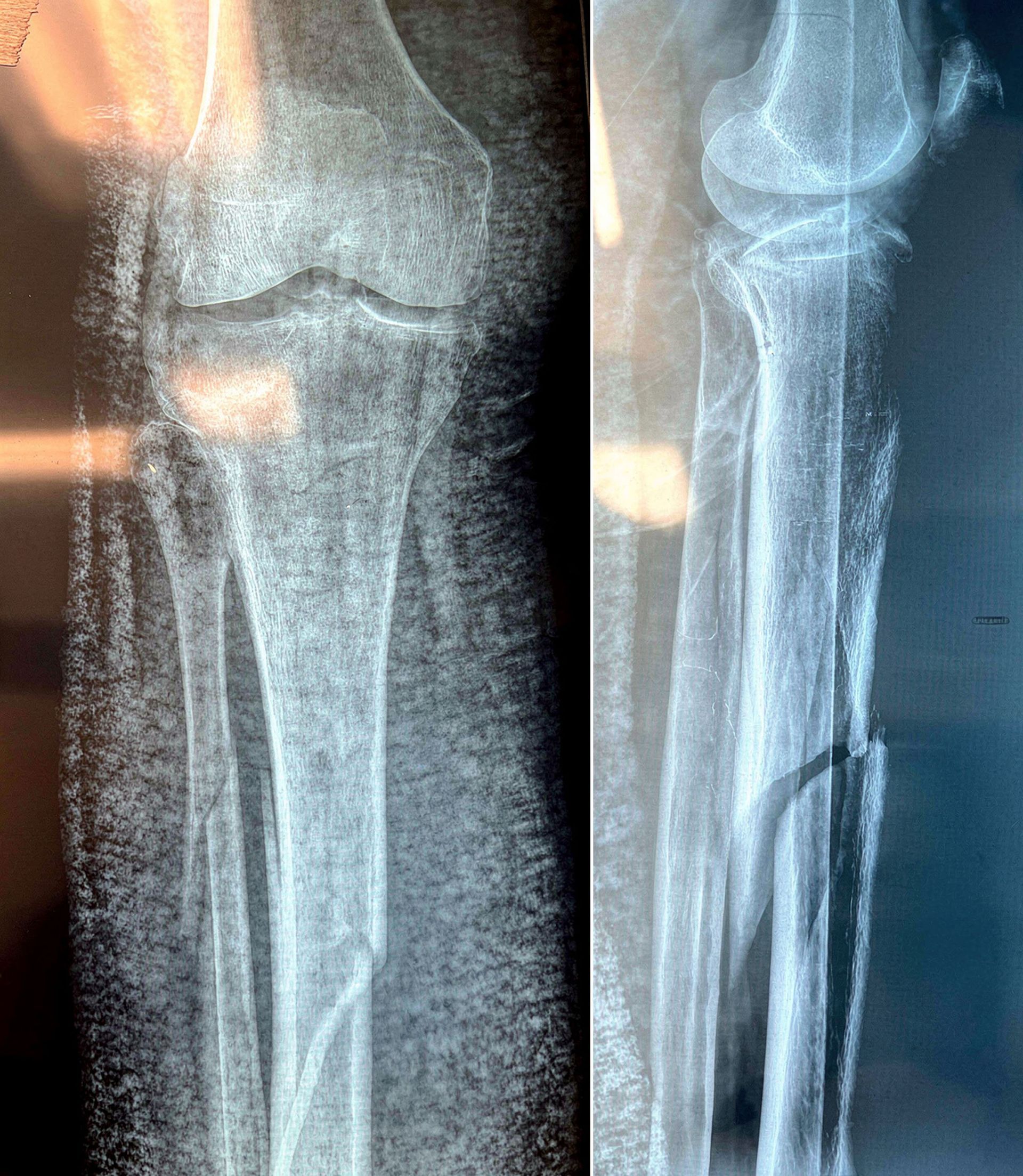 Pre-operative imaging of tibial plateau fracture